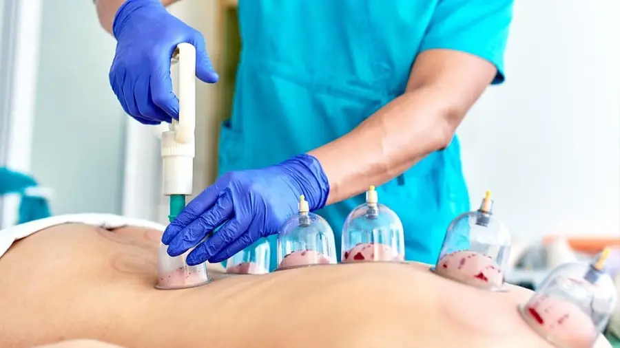 Hijama cupping therapy session